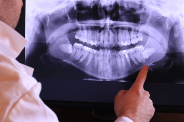 Best Emergency Dentist for Knocked-Out Tooth in Livingston, AL