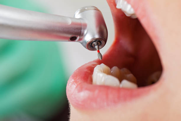 Best Broken or Cracked Tooth Emergency Dentist in Livingston, AL